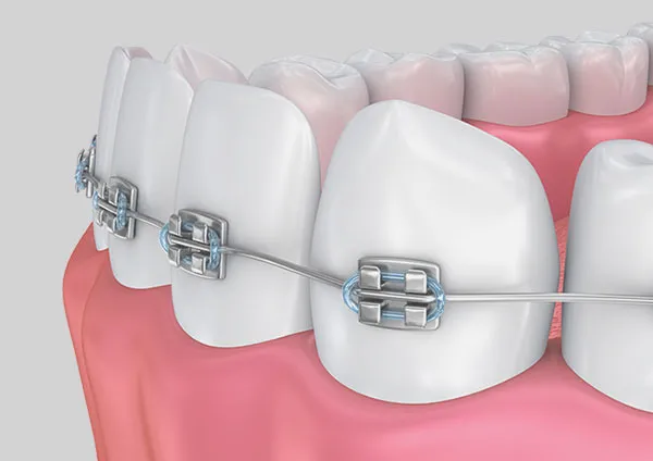 Bruxisme in de orthodontie: Effectieve corrigerende behandelingen Corrigerende behandelingen voor bruxisme in de orthodontie