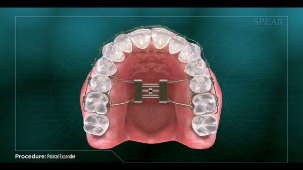 Mondgezondheid tijdens Behandeling met een Orthodontische Expander