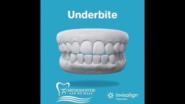 Orthodontische Expander en Mondhygiëne: Beste Praktijken