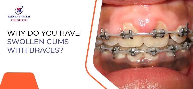 Veelvoorkomende problemen bij tandenpoetsen tijdens orthodontie en hoe deze te voorkomen