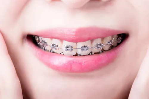 Bruxisme in de orthodontie: Effectieve corrigerende behandelingen Wat is bruxisme en hoe beïnvloedt het orthodontie?