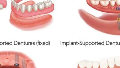 Tanden Tips - All-on-4 Gebit