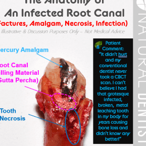 Tanden Tips - Endodontie Procedure