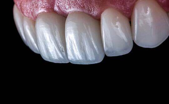 Tanden Tips - Esthetische Facings