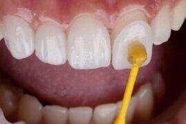 Tanden Tips - Facings Kosten