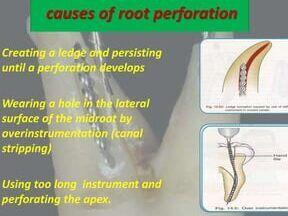 Tanden Tips - Endodontie Procedure