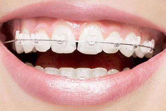 Tanden Tips - Transparante Beugels
