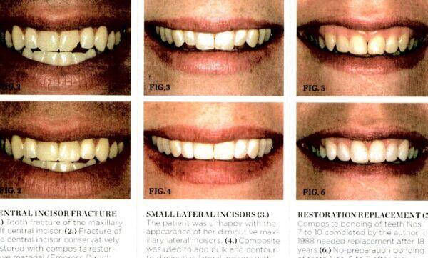 Tanden Tips - Esthetische Restauraties
