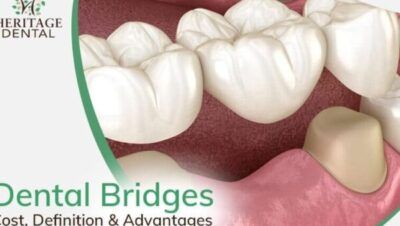 Tanden Tips - Kronen en Bruggen Kosten