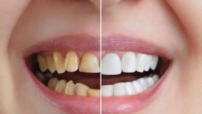 Tanden Tips - Esthetische Restauraties