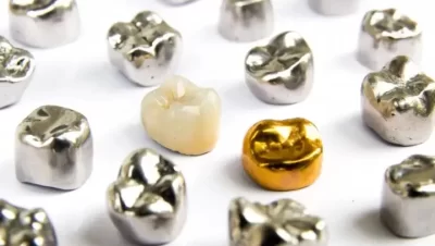 Tanden Tips - Esthetische Kronen