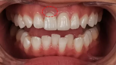 Tanden Tips - Facings Vergelijken