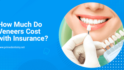 Tanden Tips - Facings Kosten