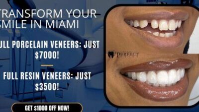 Tanden Tips - Facings Kosten