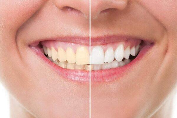 Tanden Tips - Facings Kosten