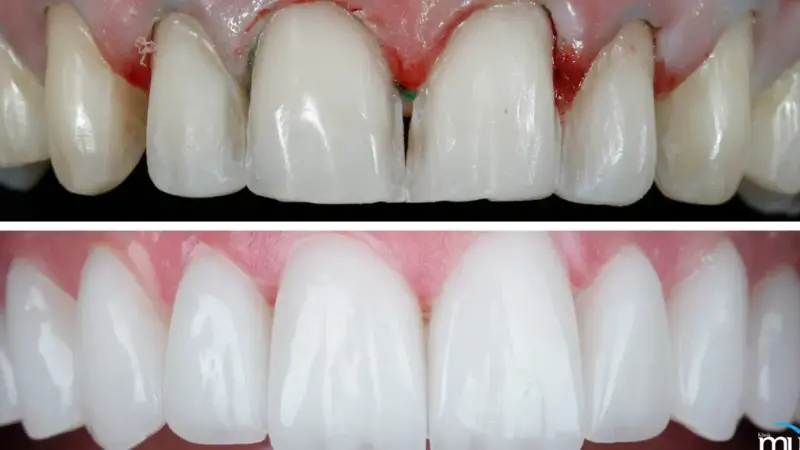 Tanden Tips - Facings