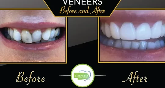Tanden Tips - Facings