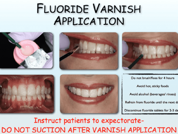 Tanden Tips - Fluoride Behandeling