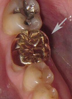 Tanden Tips - Gouden Tand