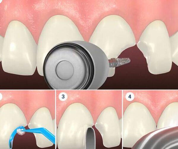 Tanden Tips - Composiet Bonding
