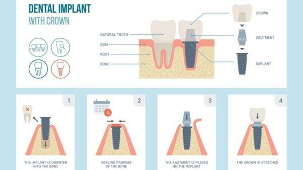 Tanden Tips - Implantaten