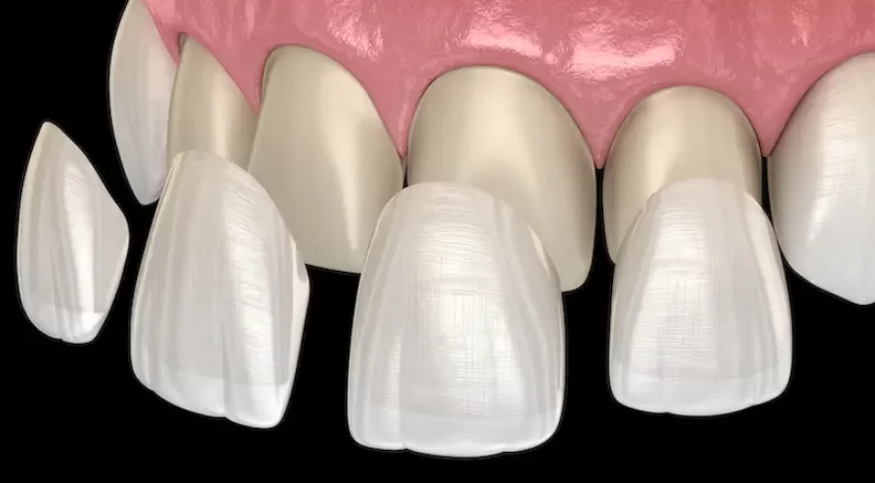 Tanden Tips - Facings