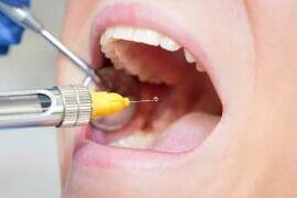 Tanden Tips - Lokale Anesthesie Tandarts