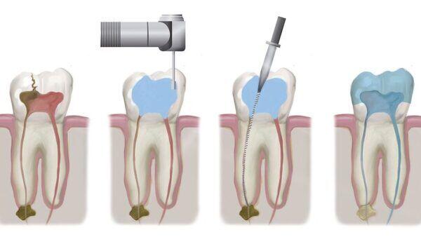 Tanden Tips - Endodontie Procedure