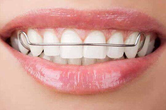 Tanden Tips - Retainer