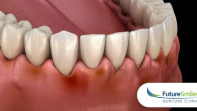 Tanden Tips - Kunstgebit Reinigen