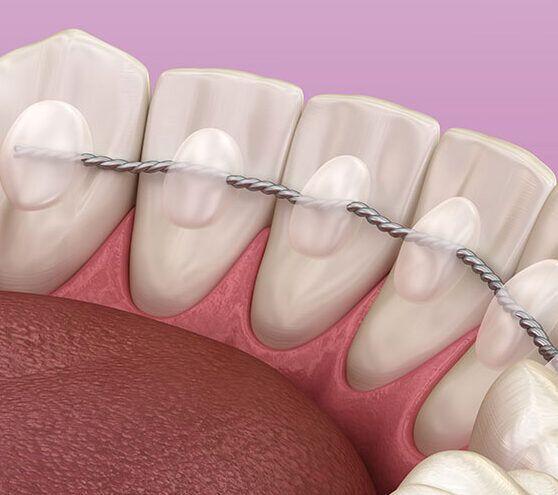 Tanden Tips - Permanente Beugel