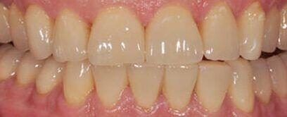Tanden Tips - Facings Kosten