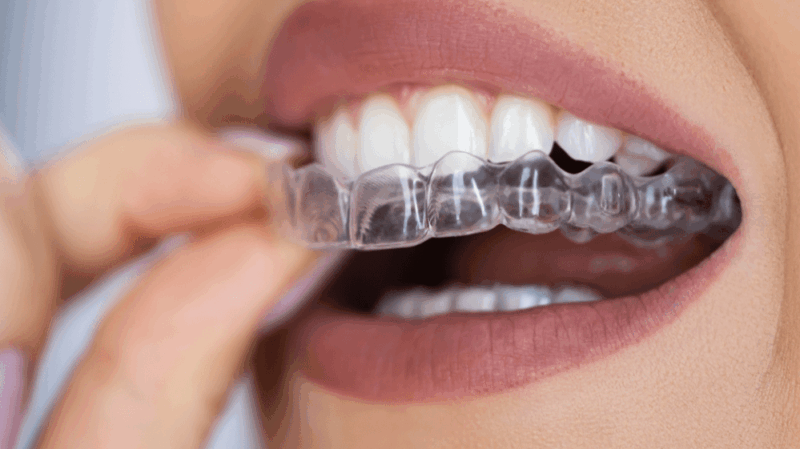 Tanden Tips - Invisalign