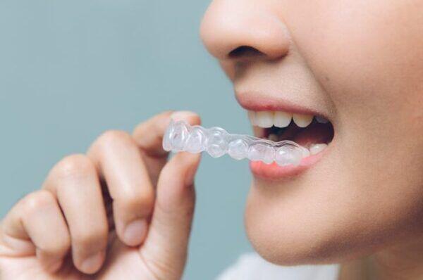 Tanden Tips - Invisalign