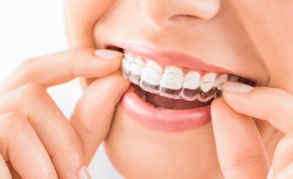 Tanden Tips - Invisalign