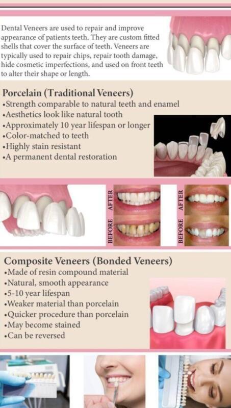 Tanden Tips - Facings
