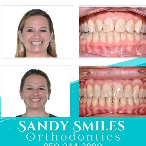 Tanden Tips - Invisalign
