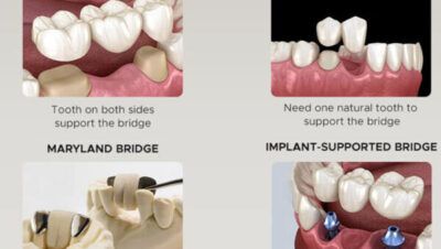 Tanden Tips - Kronen en Bruggen Kosten