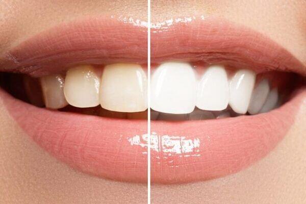 Tanden Tips - Cosmetische Tandheelkunde