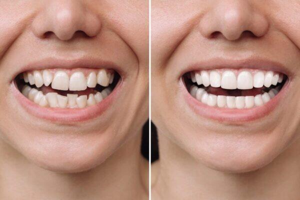 Tanden Tips - Esthetische Tandheelkundige Oplossingen