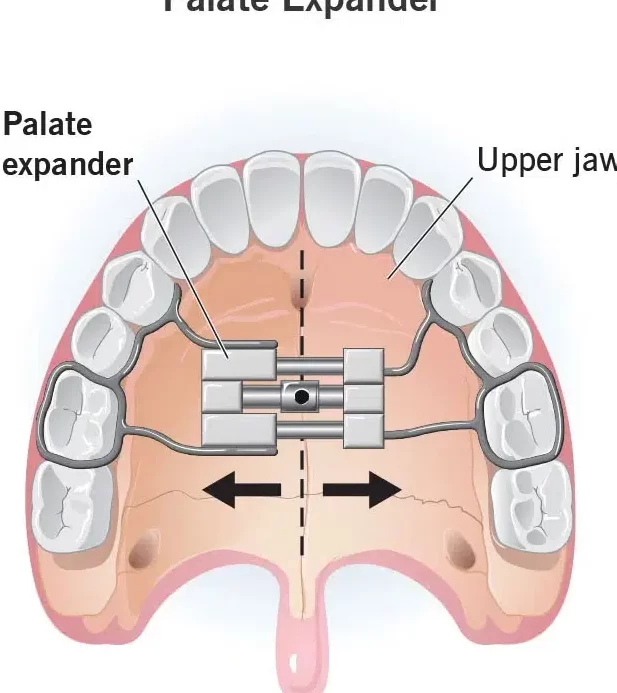 Tanden Tips - Orthodontische Expander