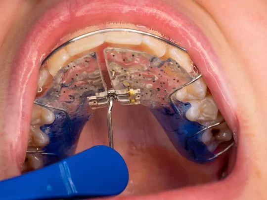 Tanden Tips - Orthodontische Expander