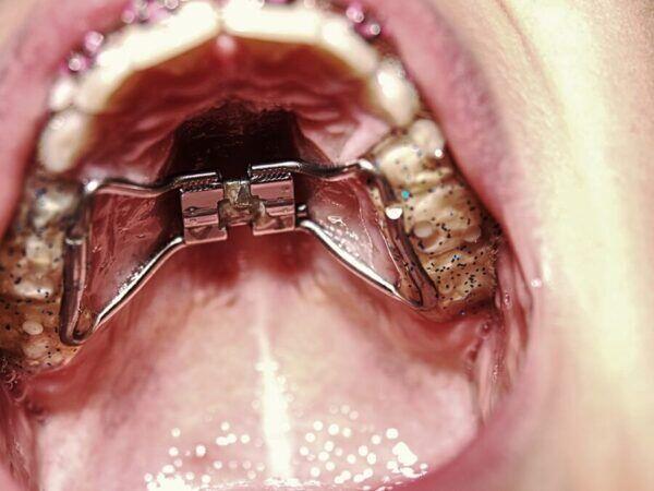Tanden Tips - Orthodontische Expander