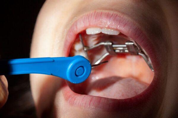 Tanden Tips - Orthodontische Expander