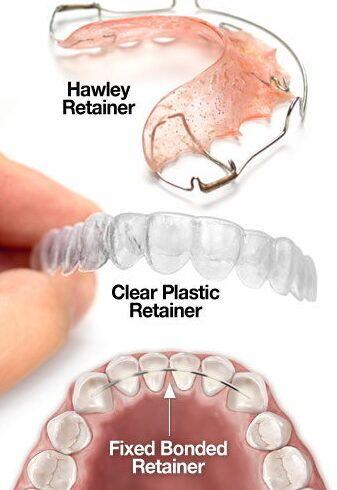 Tanden Tips - Retainer