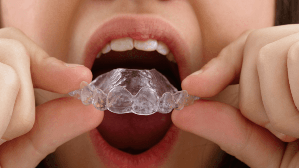 Tanden Tips - Retainer