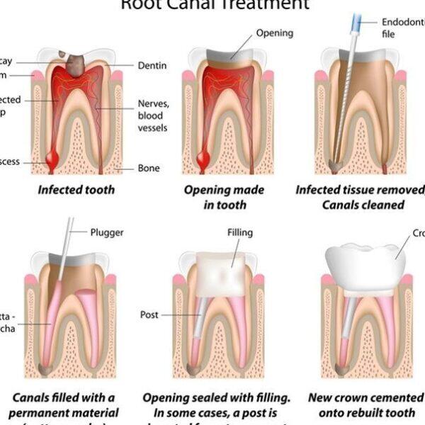 Tanden Tips - Endodontie Procedure
