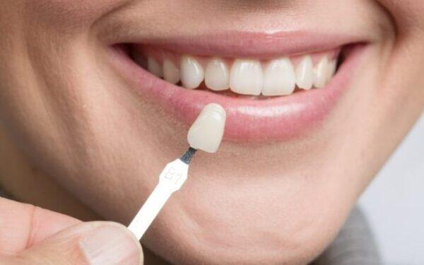Tanden Tips - Esthetische Kronen