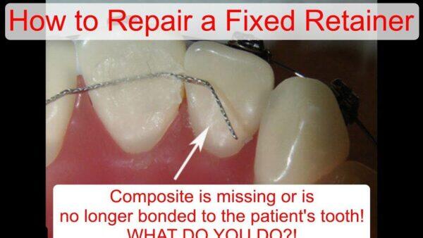 Tanden Tips - Retainer
