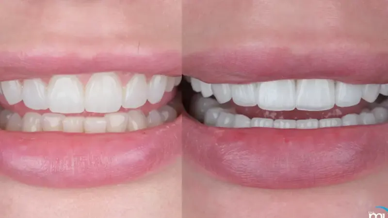 Tanden Tips - Esthetische Facings
